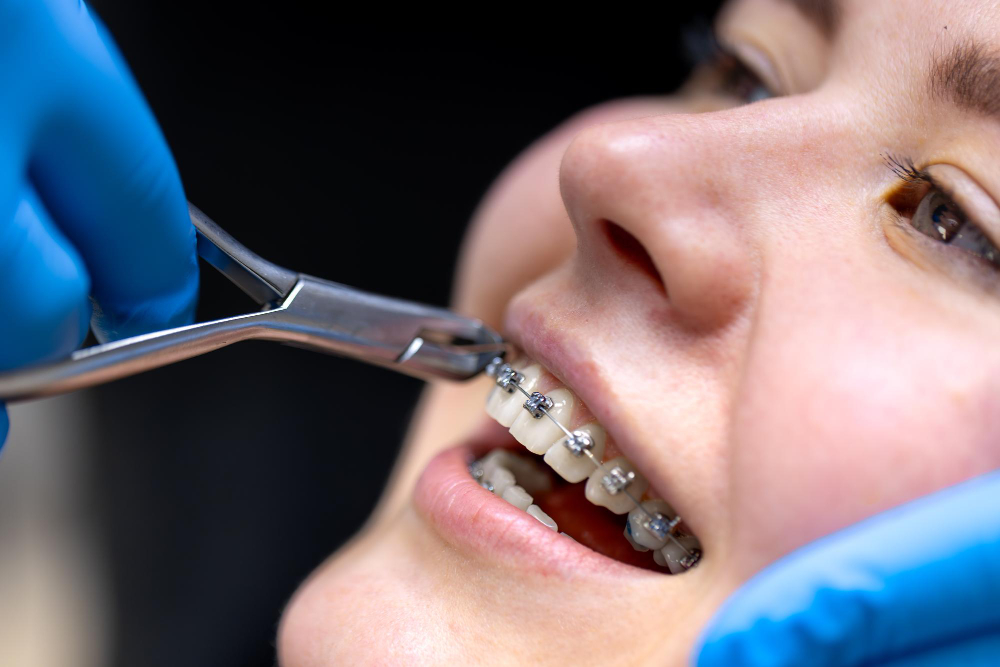 Orthodontist adjusting dental braces to improve teeth alignment in Chandigarh.