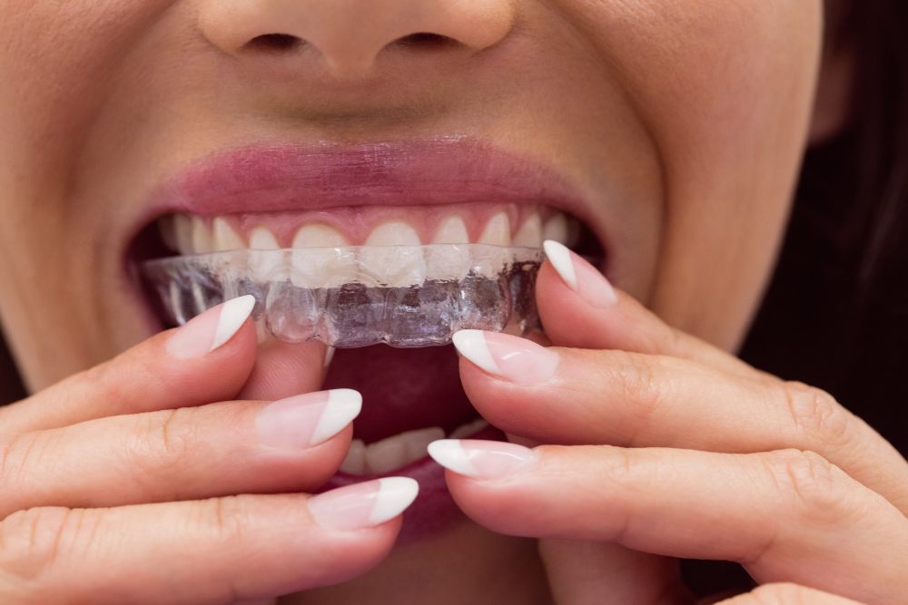 Invisalign Clear Aligners