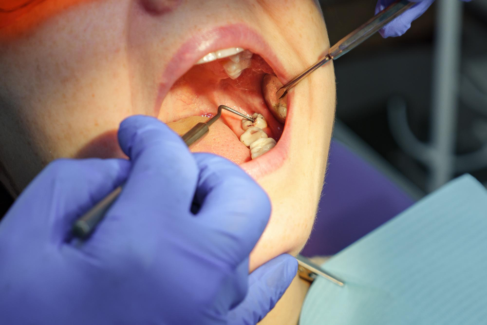 Dental examination before impacted wisdom tooth removal in Chandigarh.