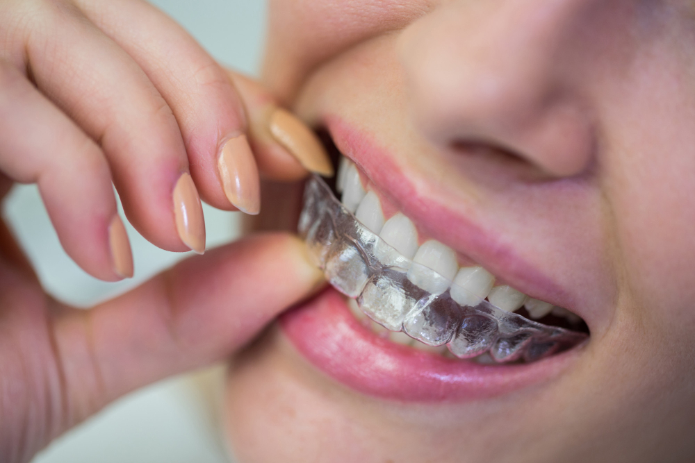 Patient wearing invisible braces for comfortable teeth straightening in Chandigarh.