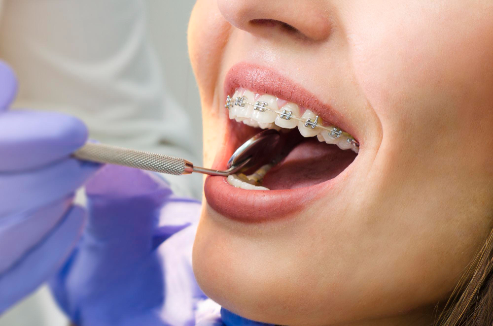 Dentist examining metal braces during orthodontic treatment in Chandigarh.