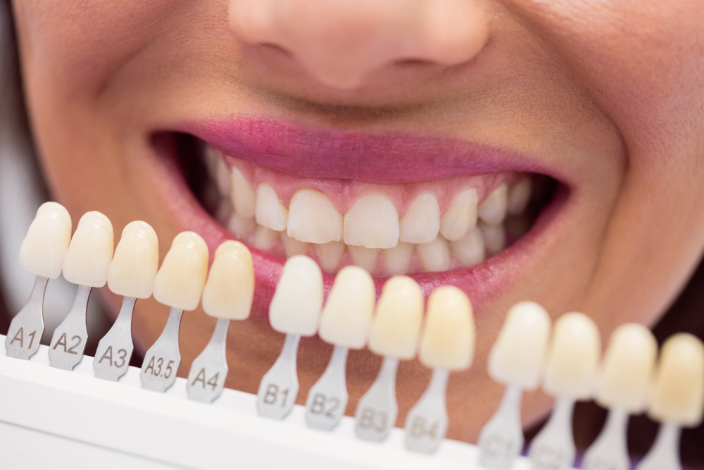 Natural looking dental veneers matched with the patient’s tooth colour in Chandigarh.