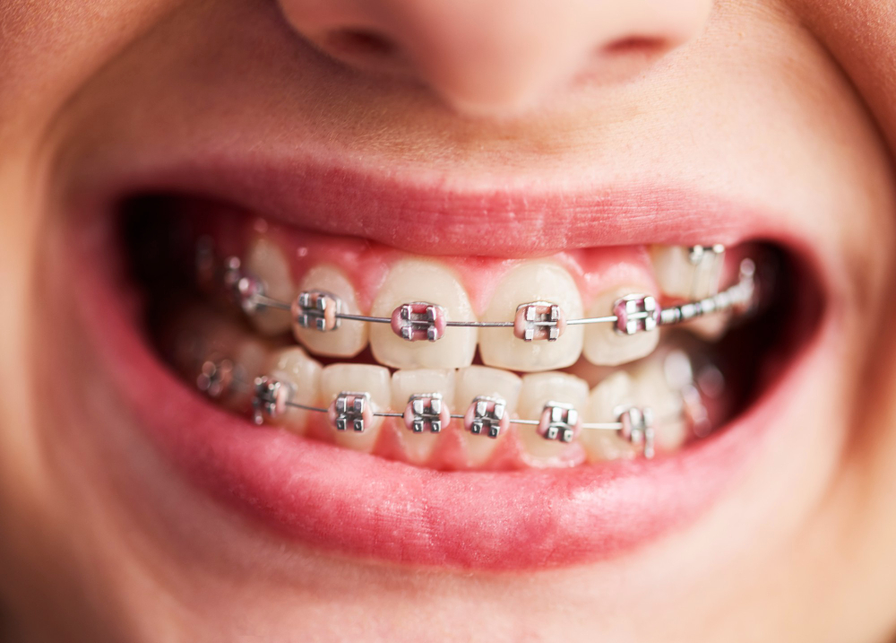 Close view of orthodontic metal braces used to straighten teeth in Chandigarh.