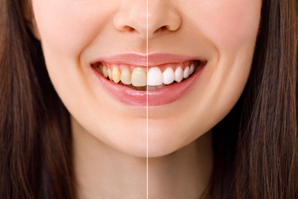 Before and after results of professional teeth cleaning in Chandigarh.