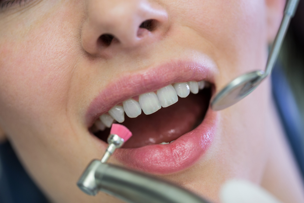 Professional teeth polishing treatment for a cleaner and brighter smile in Chandigarh.