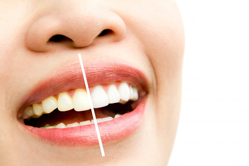 Visible improvement after teeth cleaning and whitening treatment in Chandigarh.