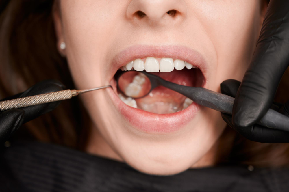 Tooth restoration treatment for cavities and damaged teeth at RK Dental Practice in Chandigarh.