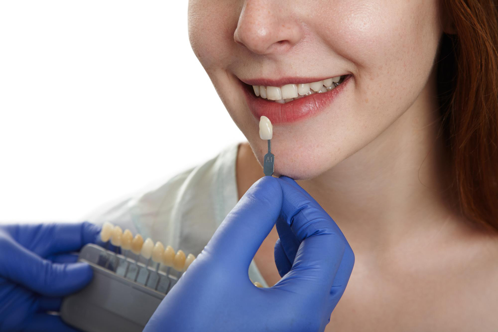 Dental veneer shade selection during cosmetic dental treatment in Chandigarh.