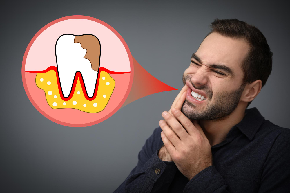 Pyorrhea Treatment in Chandigarh