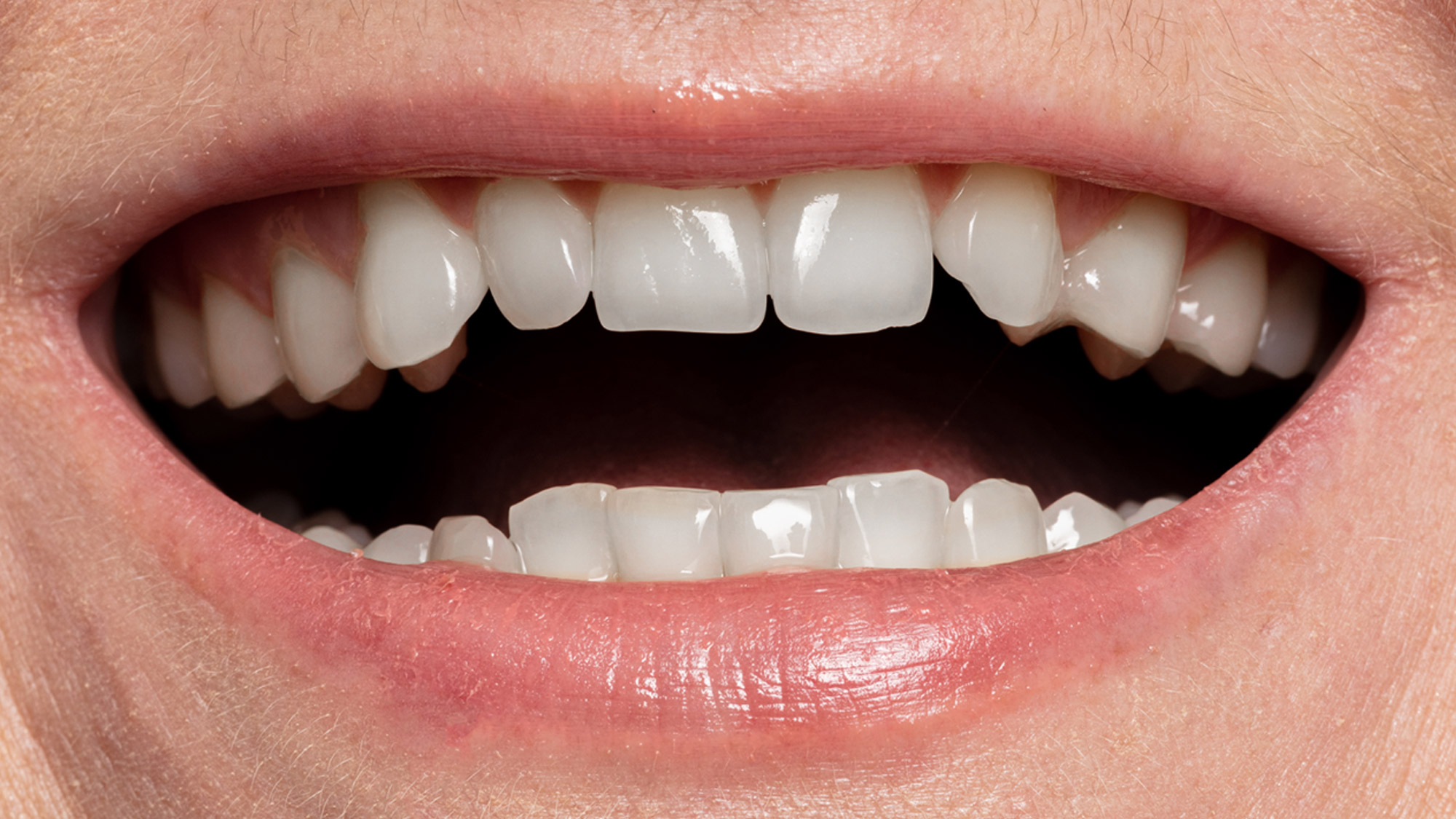 Smile after cosmetic dental treatment