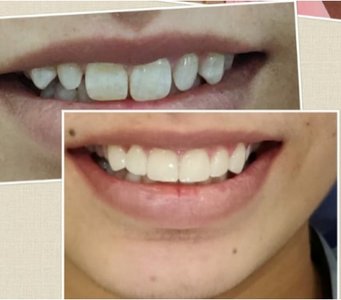 dental veneers smile design chandigarh